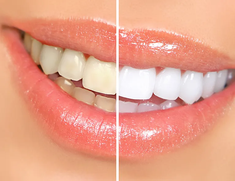Diş Beyazlatma (Bleaching)