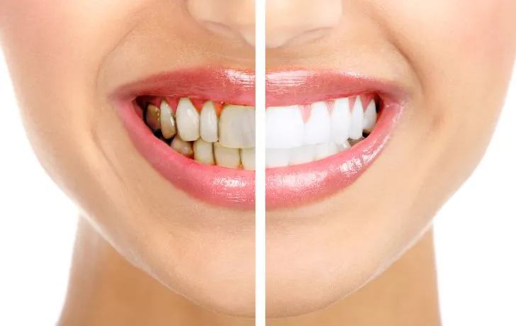 Periodontoloji (Diş Eti)